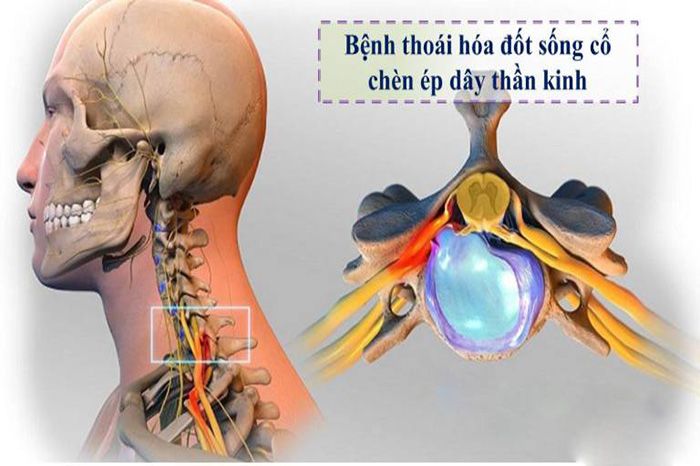Rối loạn tiền đình do thoái hóa đốt sống cổ có nguy hiểm không?
