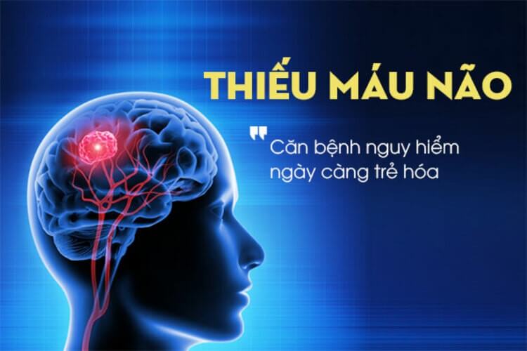 Bệnh thiếu máu não: 6 triệu chứng không thể coi thường