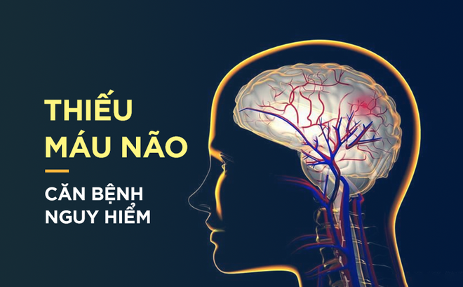 Thiếu máu não: Căn bệnh hàng đầu gây đột quỵ bất ngờ